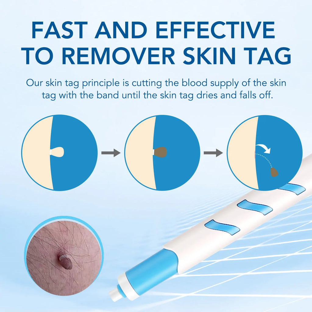 3 In 1 Painless Auto Skin Tag/Mole/Wart Removal Kit
