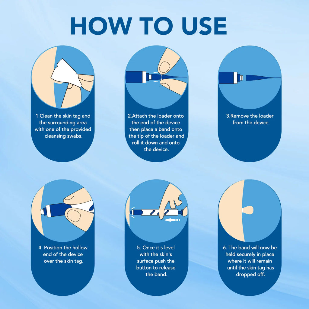 3 In 1 Painless Auto Skin Tag/Mole/Wart Removal Kit